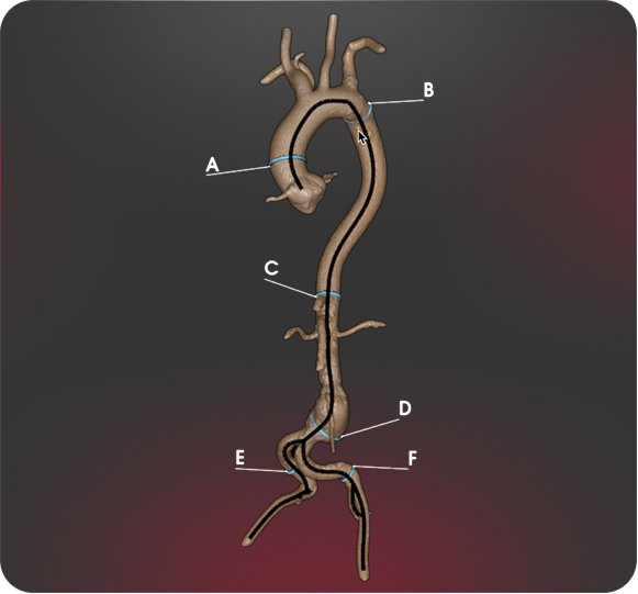 Aortic Hero Glass Pane