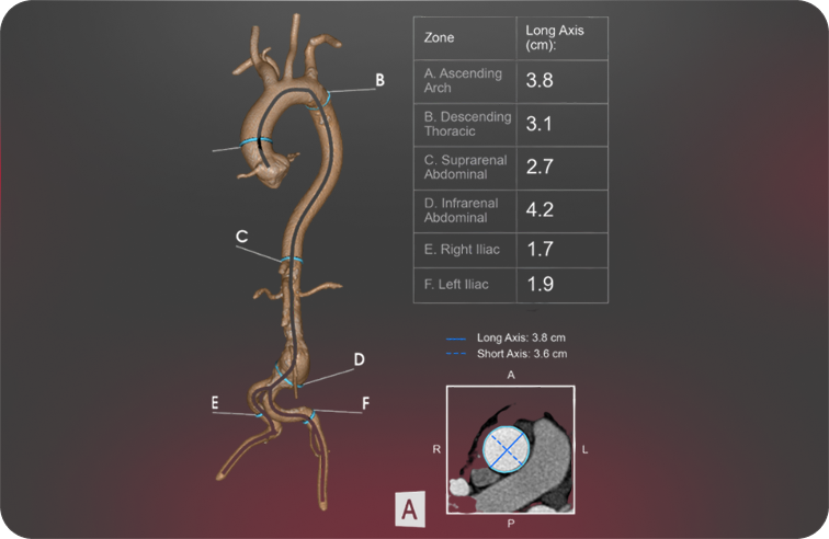 Aortic_web-hero_756x492