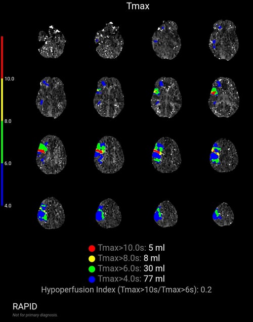 CTP CBF_30% volume 0 ml, Tmax_6s volume 30 ml, AnonID 766c_2363648_MeVO_Tmax Thresholds