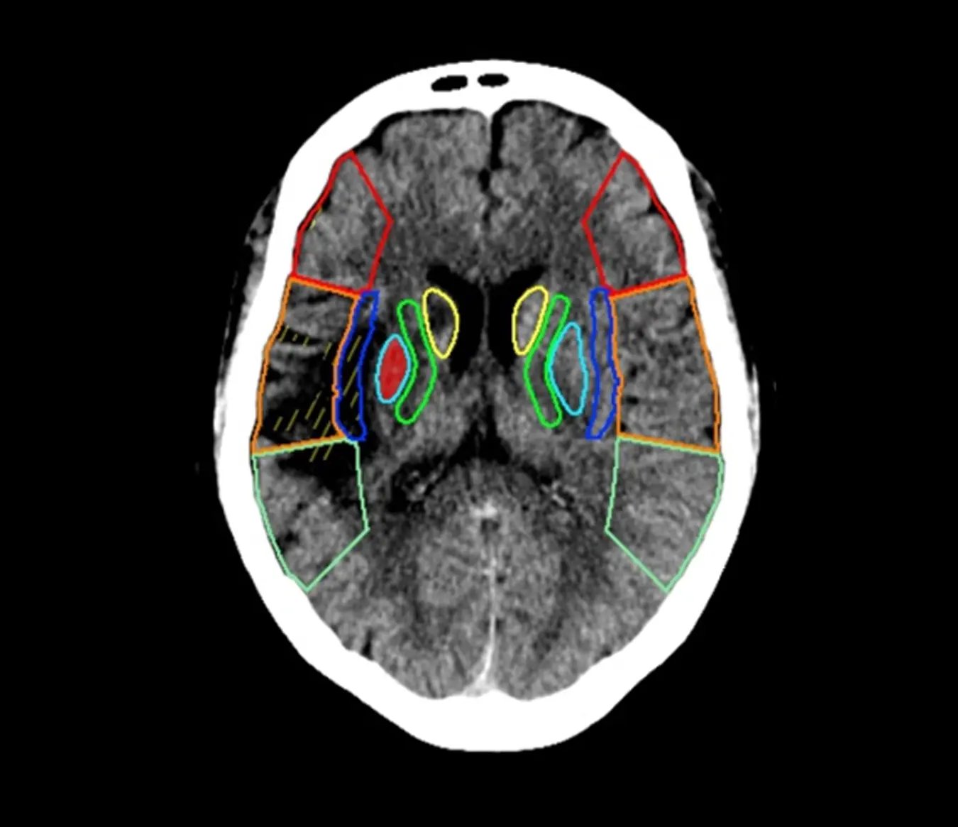 Deep clinical AI ASPECTS