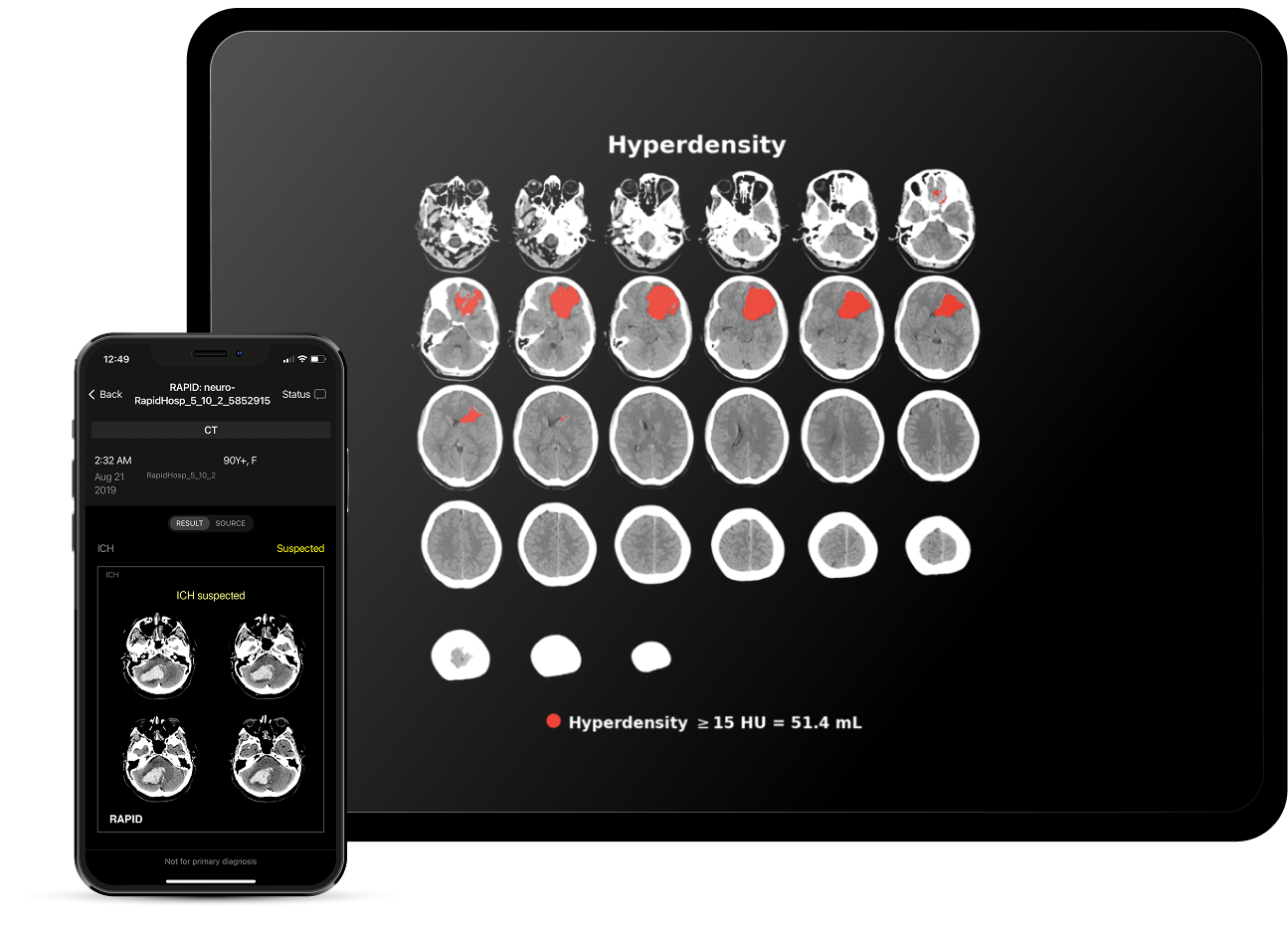 ICH-Hyperdensity-product