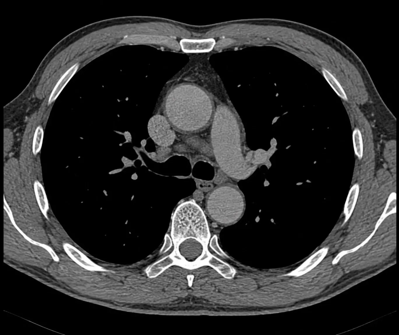 Longitudinal standard Aorta