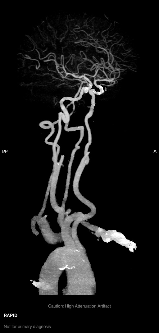 Lumina3D Caroline Carotid