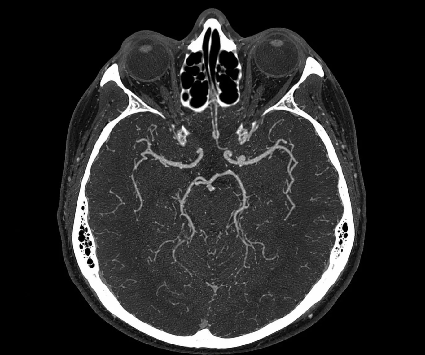 Quantification Aneurysm
