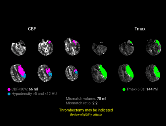 Stroke-Guidelines_img-1