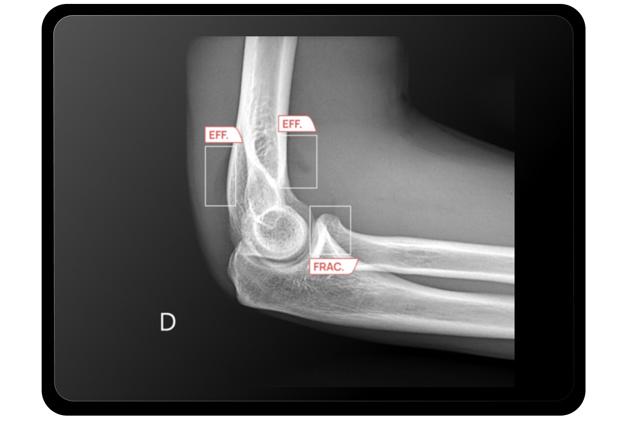 Website_MSK-fractures