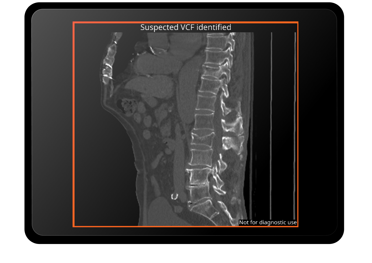 Website_spine-fractures