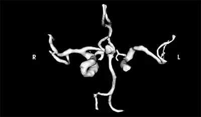 Aneurysm_ACOM_cropped_web