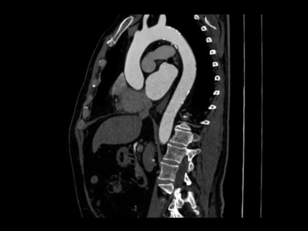 Aortic 3D Visualization