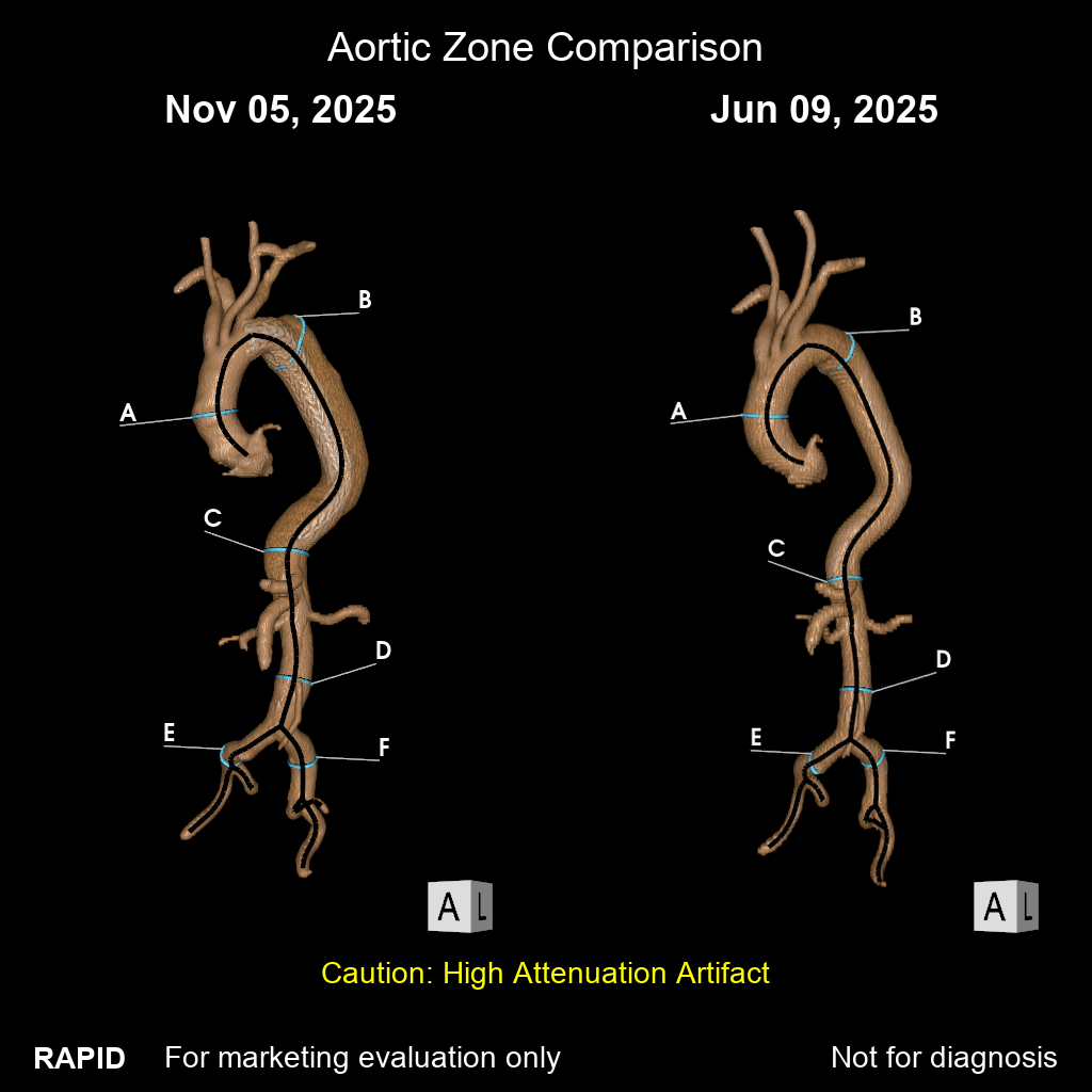 Aortic Comparison_image_1